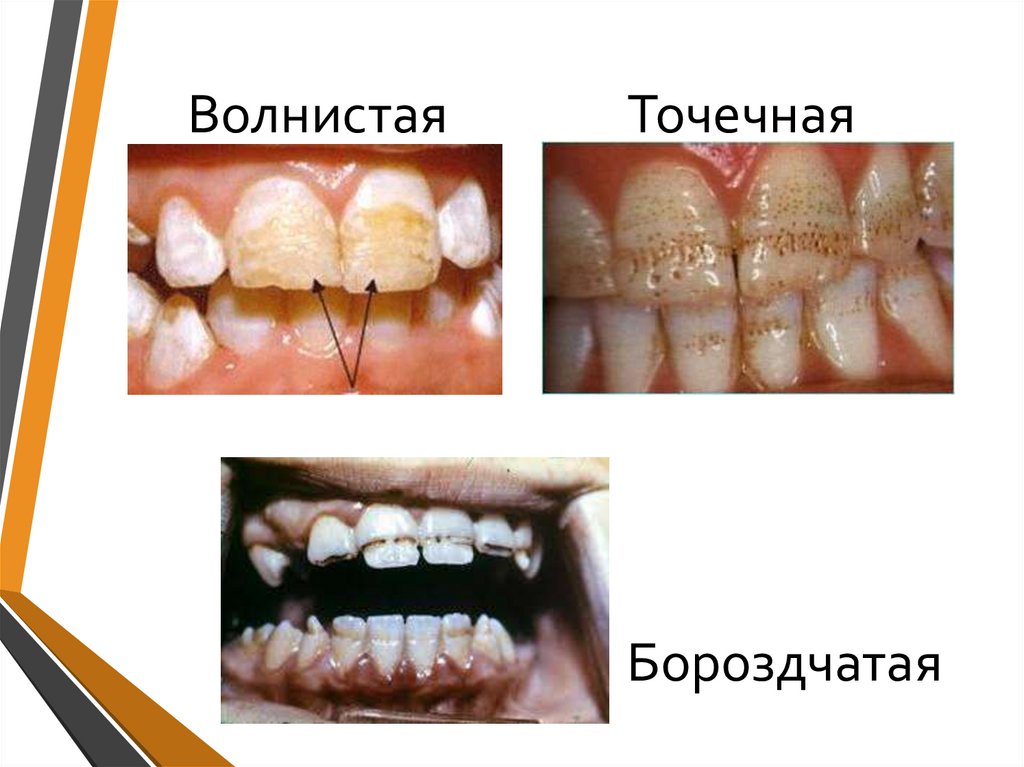 Волнистая Точечная Бороздчатая