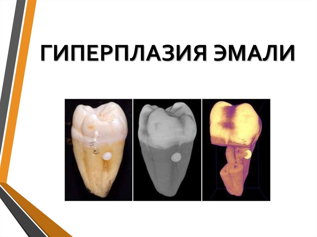 ГИПЕРПЛАЗИЯ ЭМАЛИ