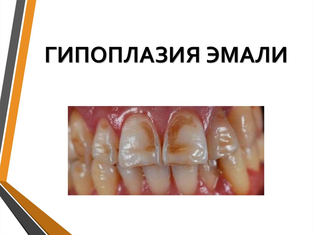 ГИПОПЛАЗИЯ ЭМАЛИ