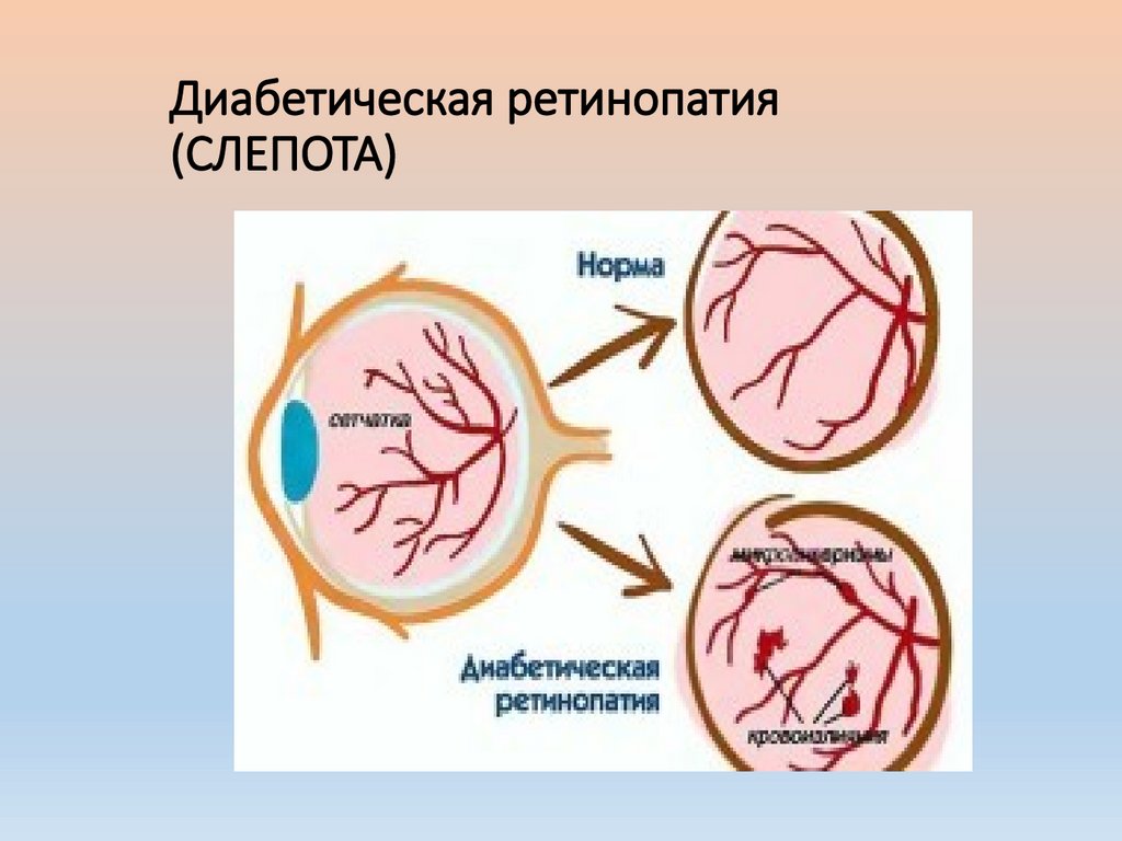 Диабетическая ретинопатия (СЛЕПОТА)