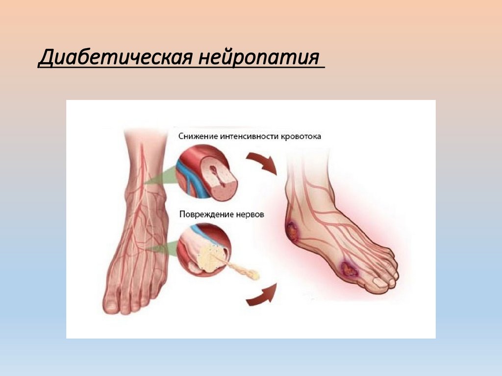 Диабетическая нейропатия