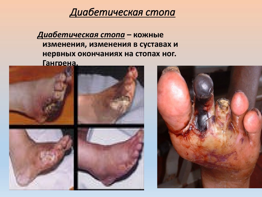 Диабетическая стопа