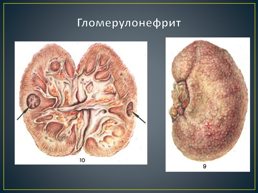 Гломерулонефрит