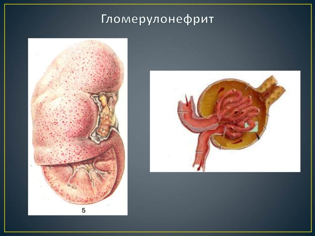 Гломерулонефрит