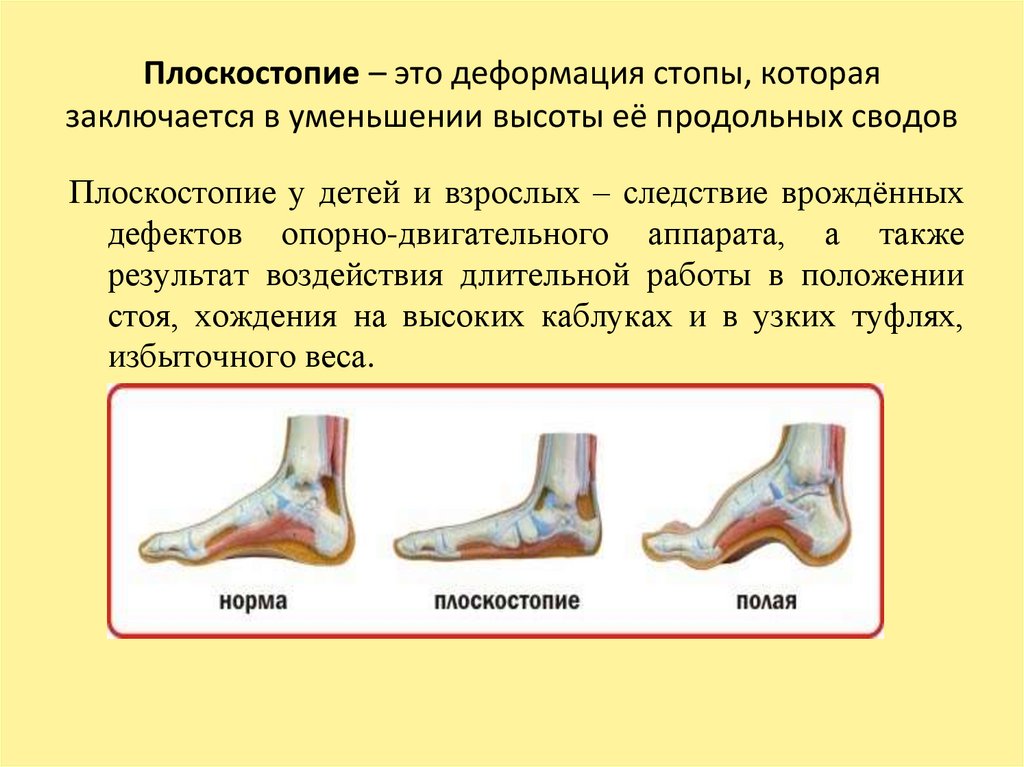 Плоскостопие – это деформация стопы, которая заключается в уменьшении высоты её продольных сводов