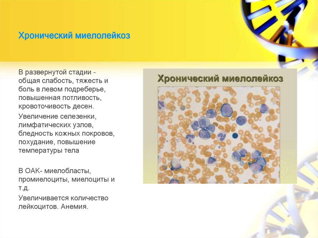 Хронический миелолейкоз