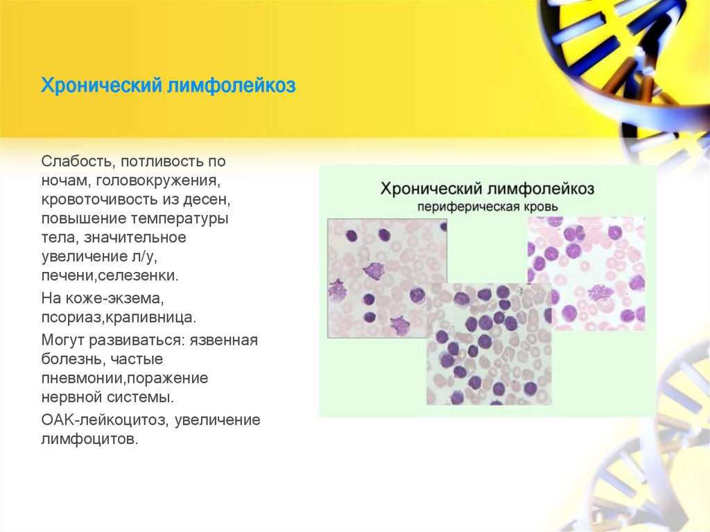 Хронический лимфолейкоз