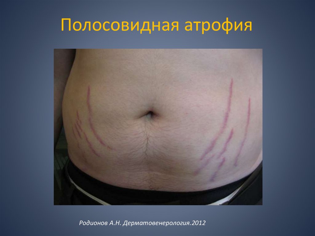 Полосовидная атрофия