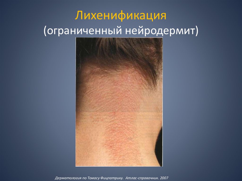 Лихенификация (ограниченный нейродермит)