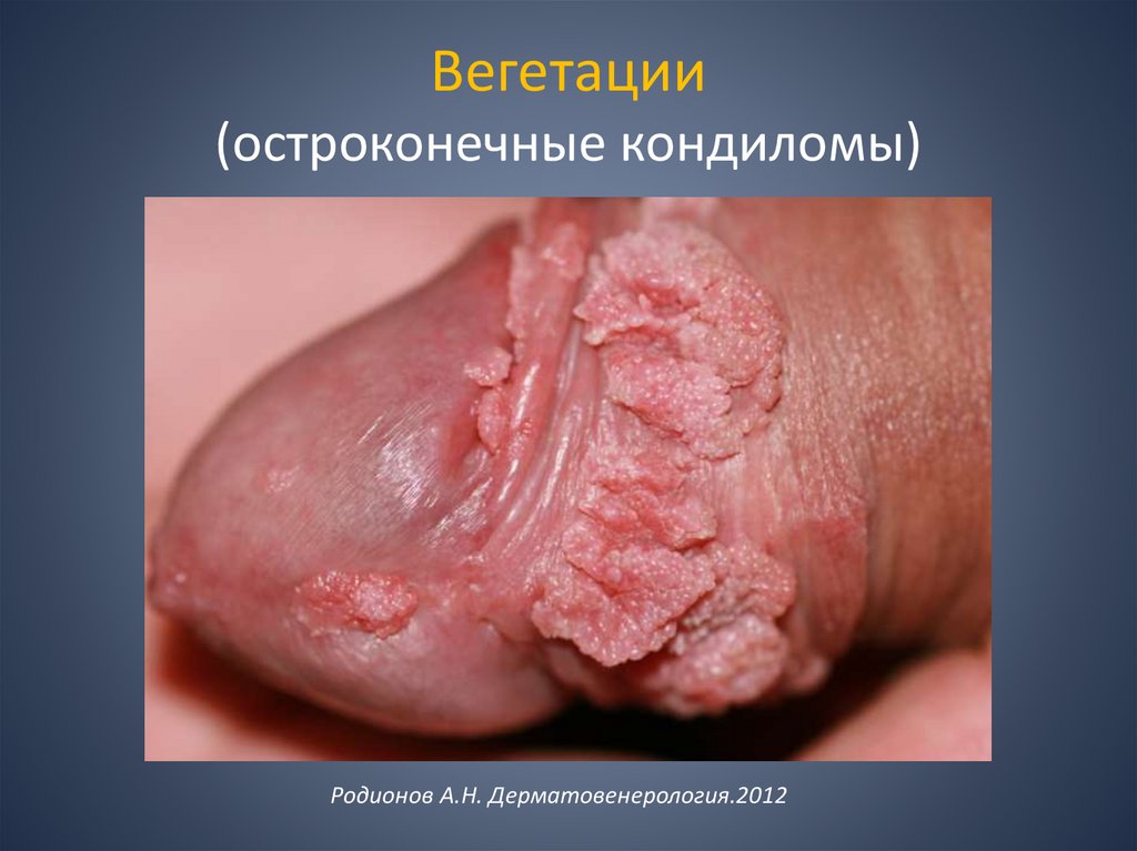 Вегетации (остроконечные кондиломы)