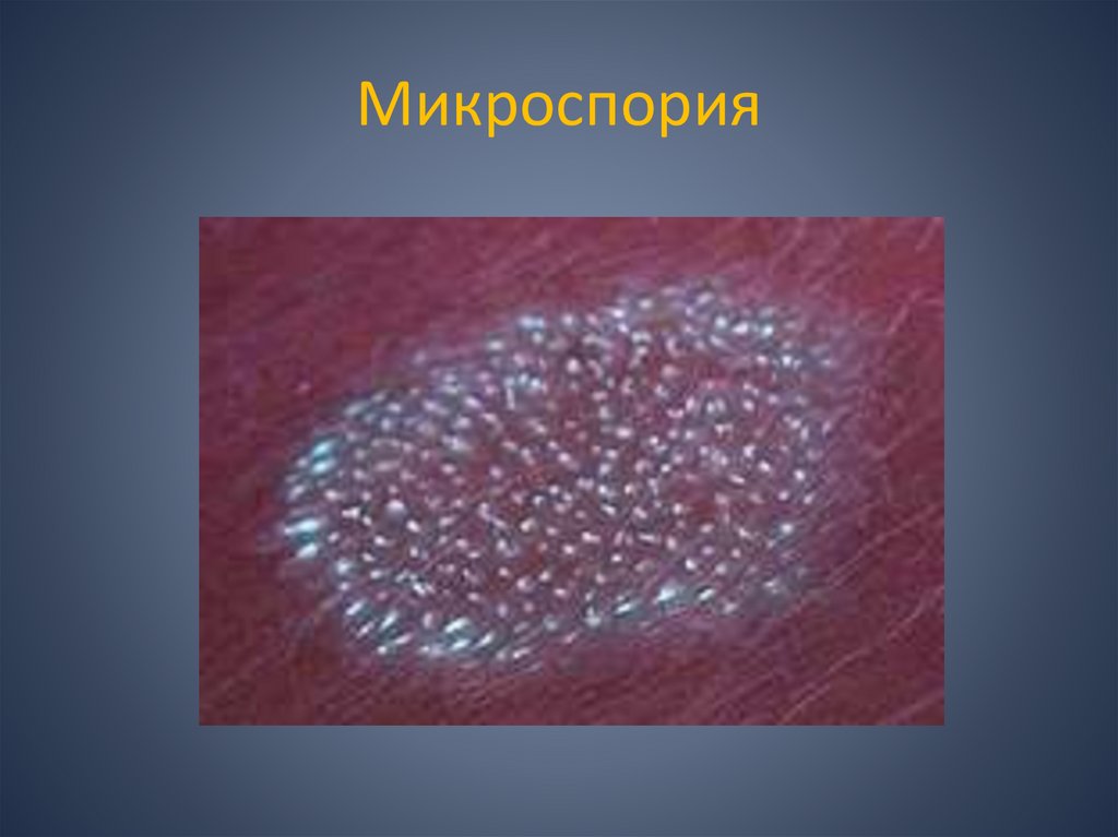 Микроспория