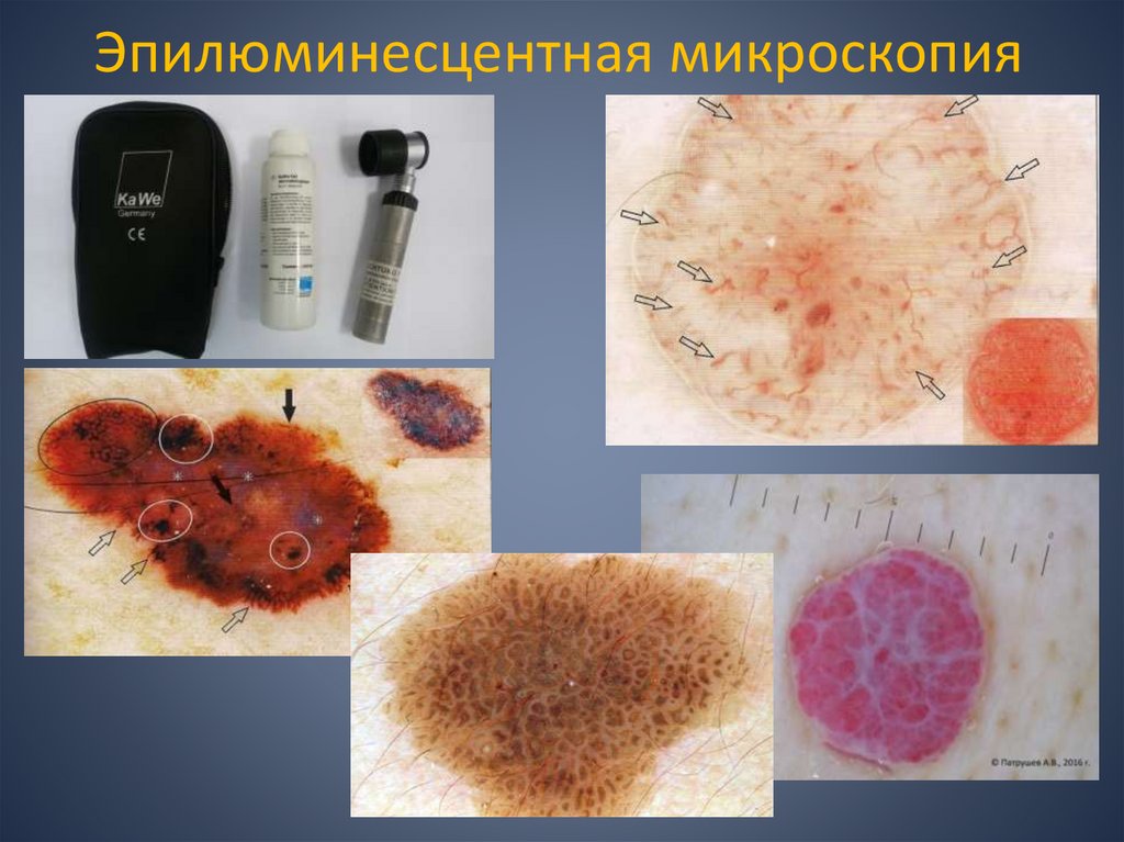 Эпилюминесцентная микроскопия