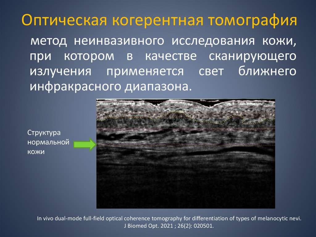 Оптическая когерентная томография