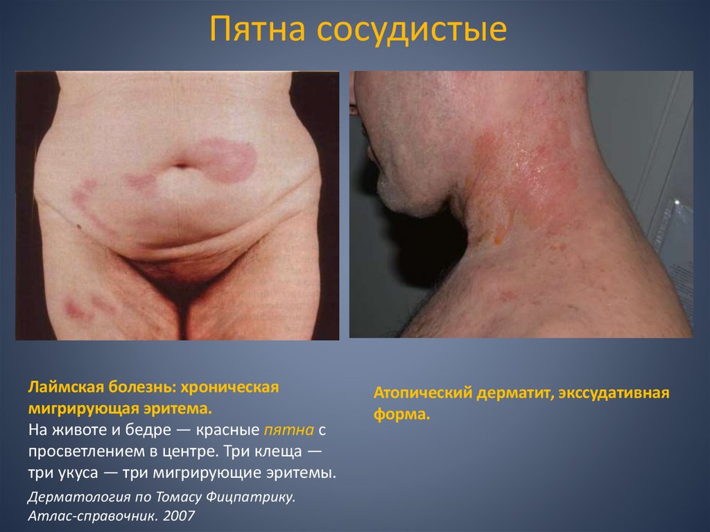 Пятна сосудистые