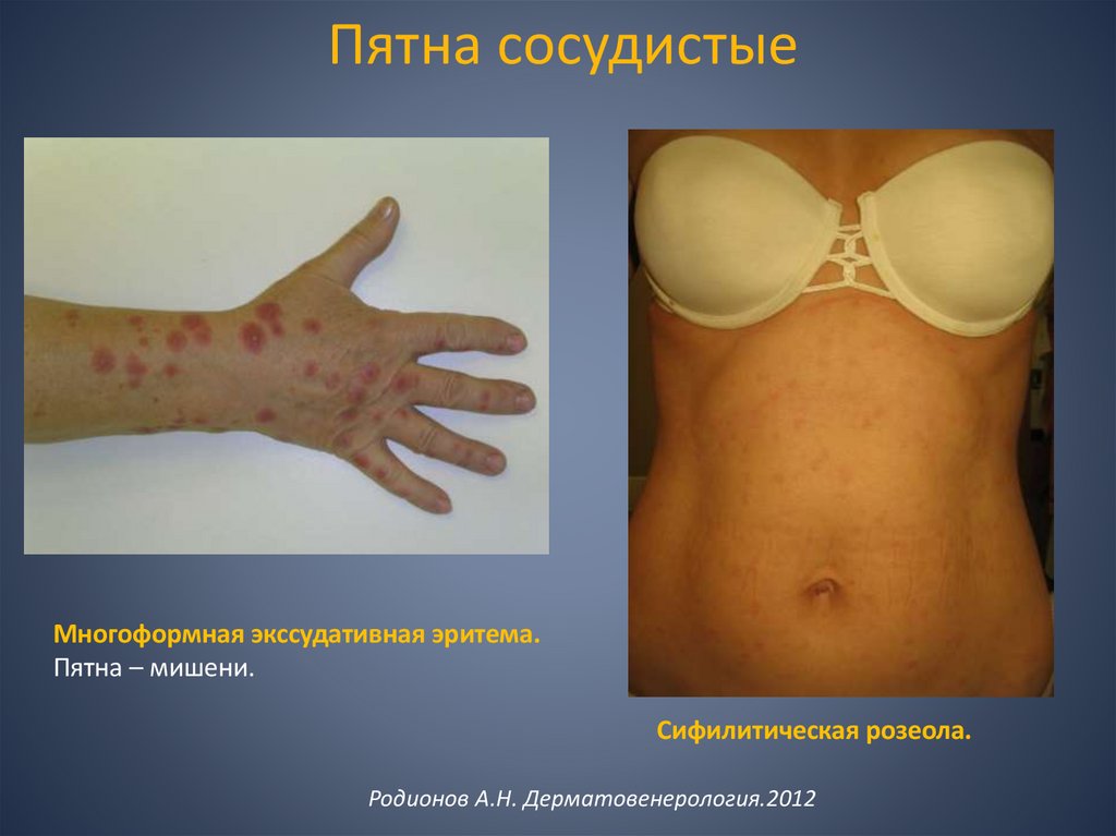 Пятна сосудистые