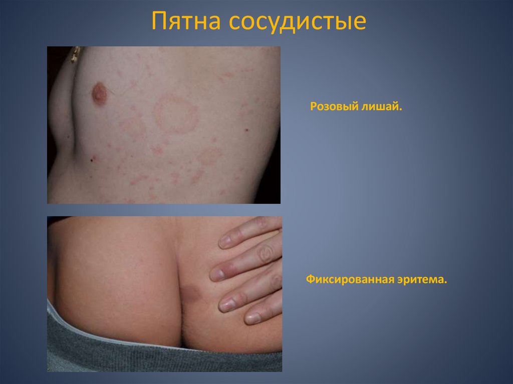 Пятна сосудистые