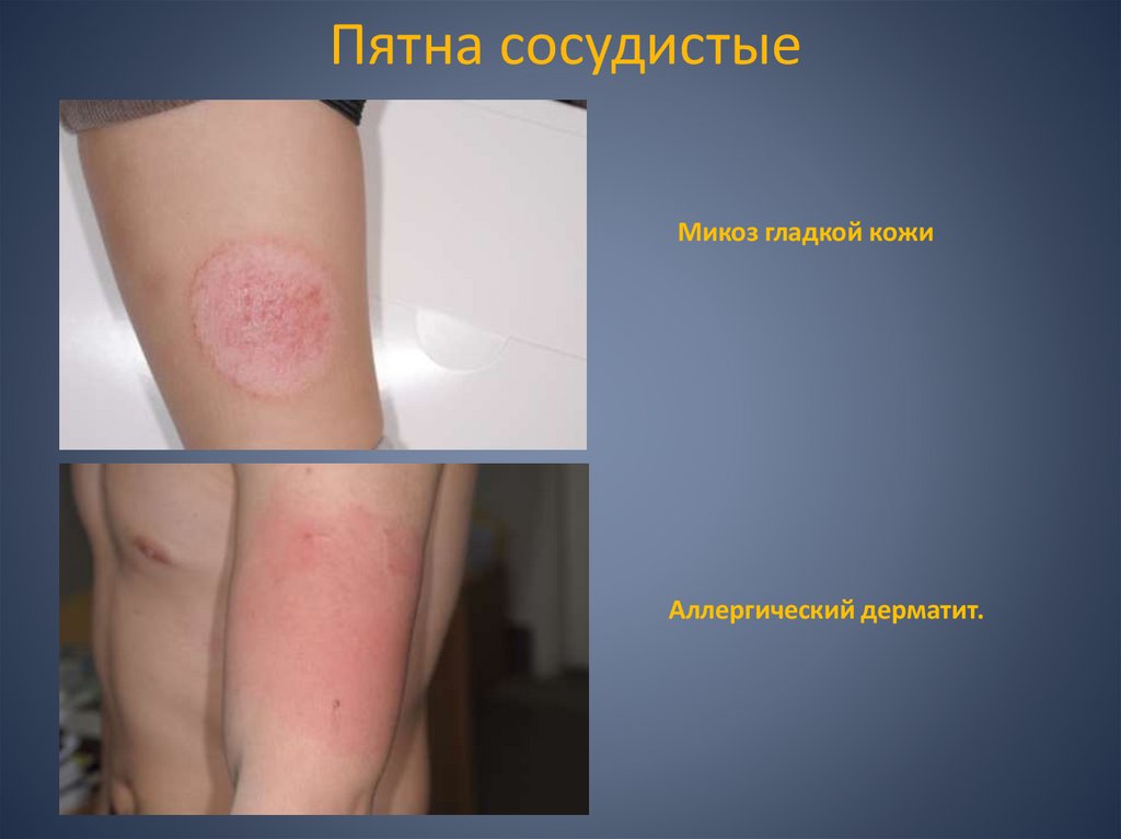 Пятна сосудистые