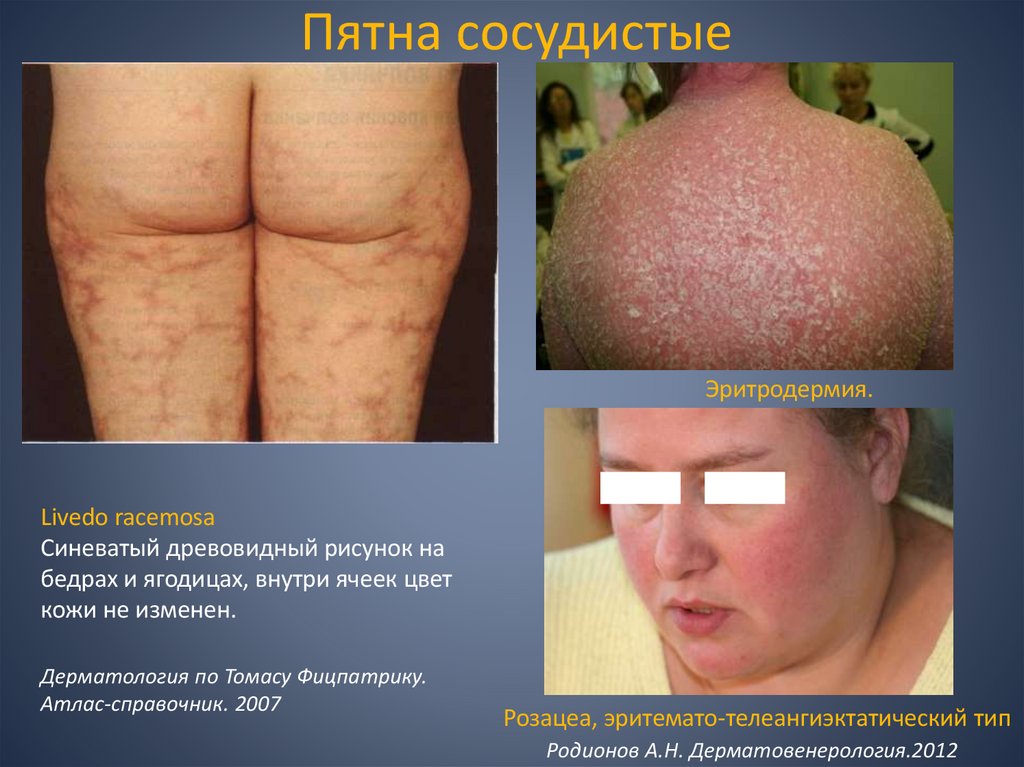 Пятна сосудистые