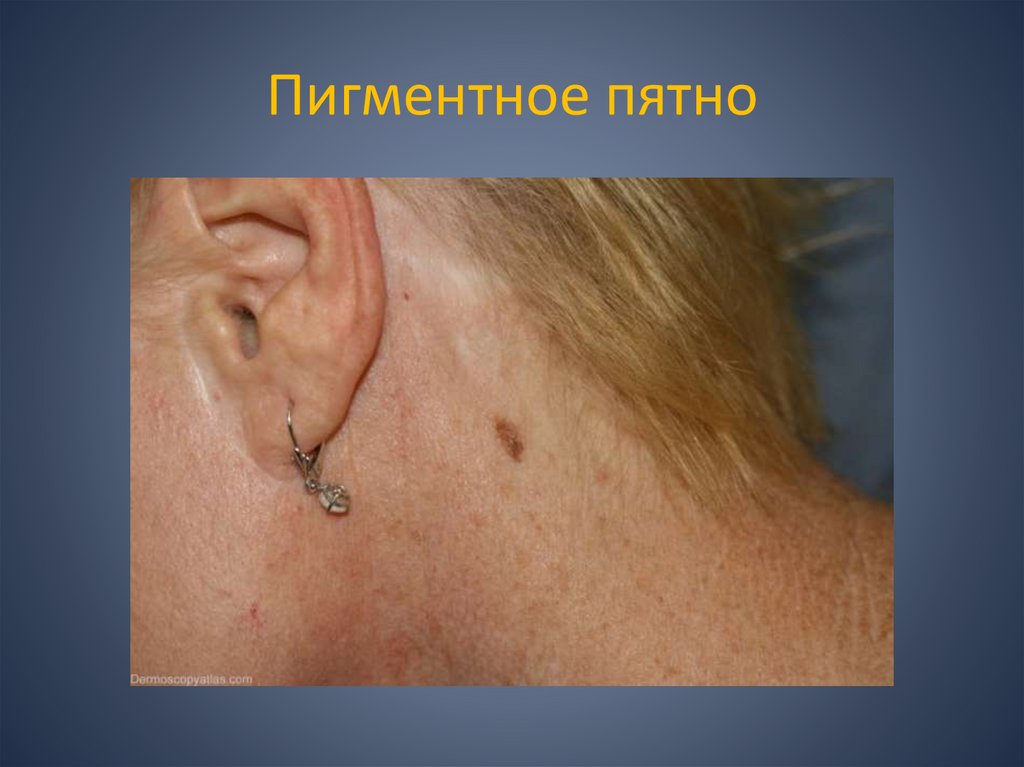 Пигментное пятно