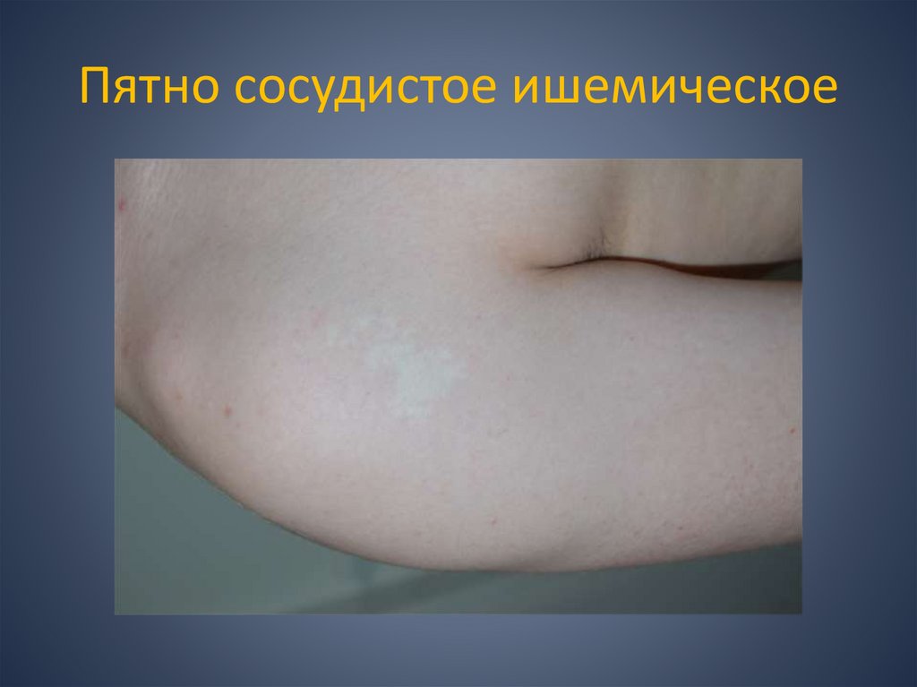Пятно сосудистое ишемическое