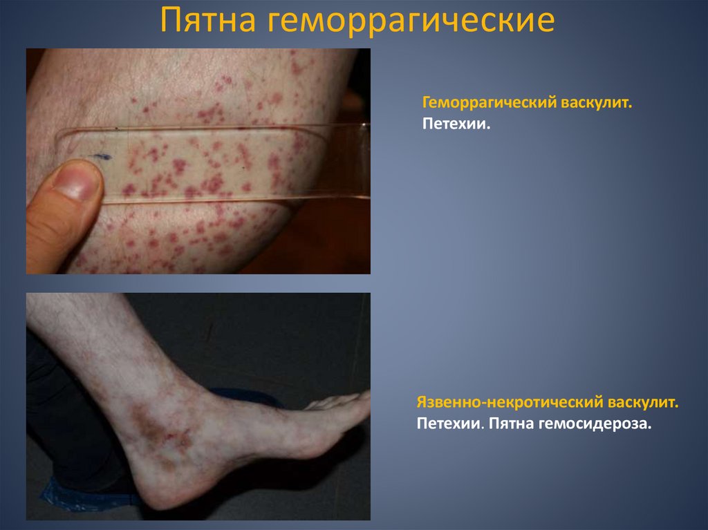 Пятна геморрагические