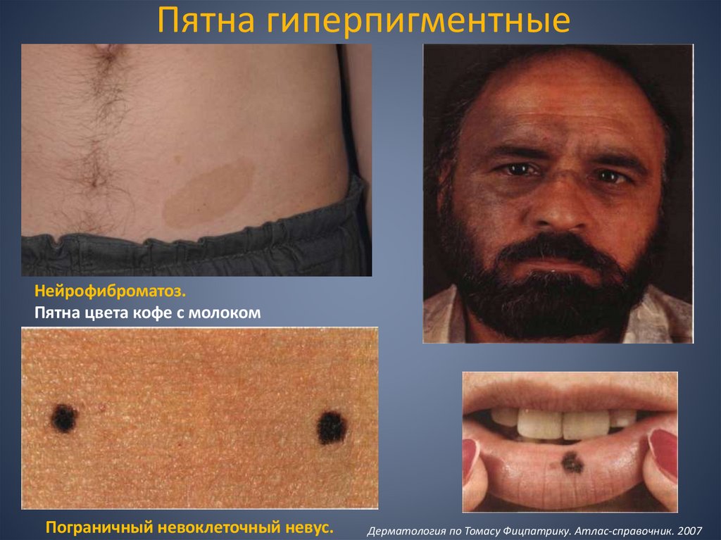 Пятна гиперпигментные