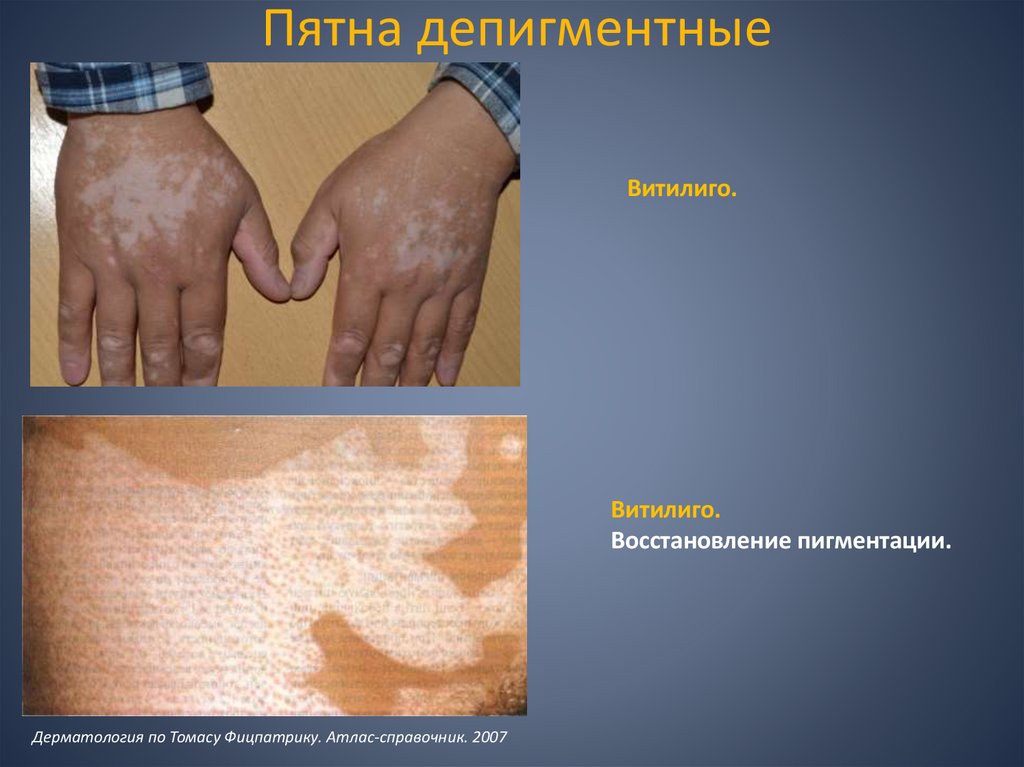 Пятна депигментные