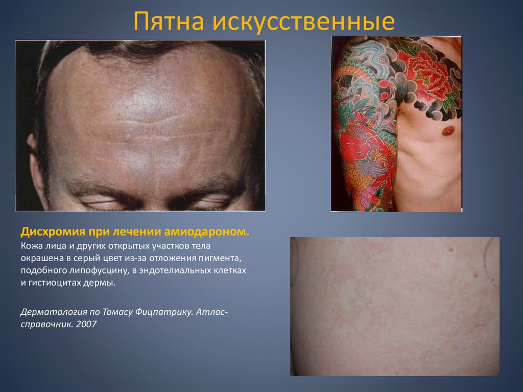 Пятна искусственные