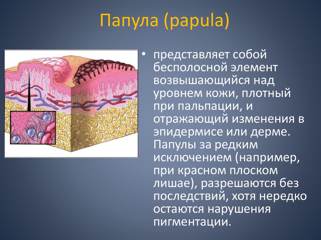 Папула (papula)