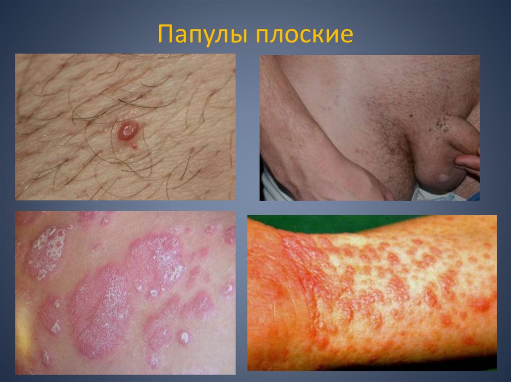 Папулы плоские