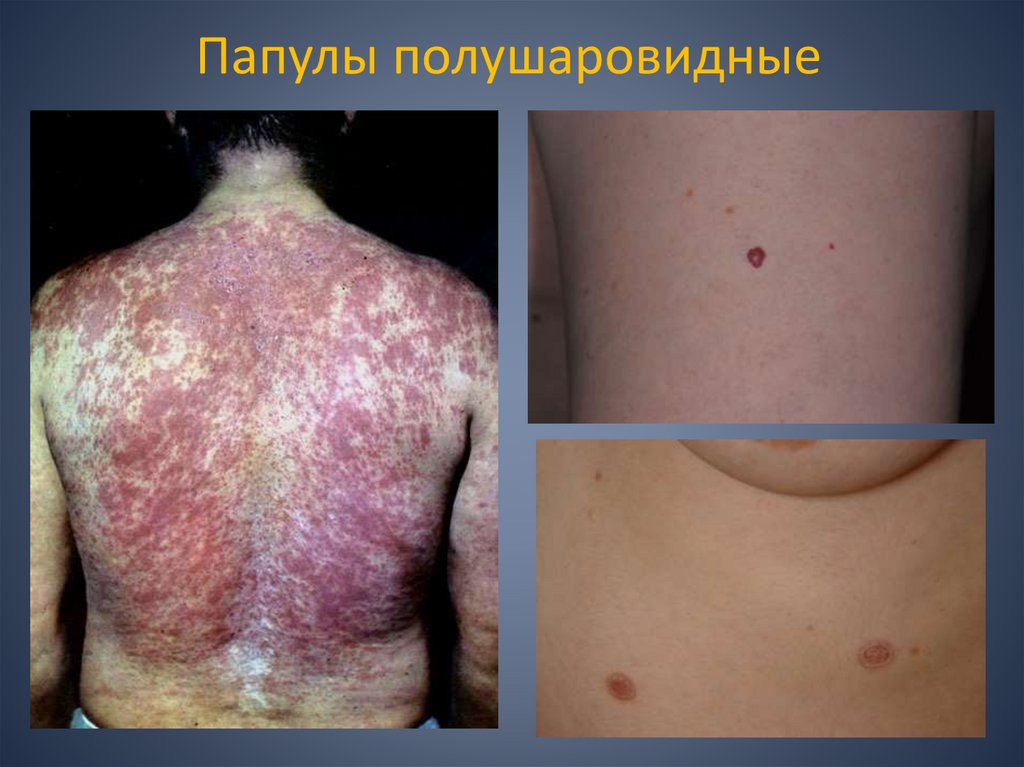 Папулы полушаровидные