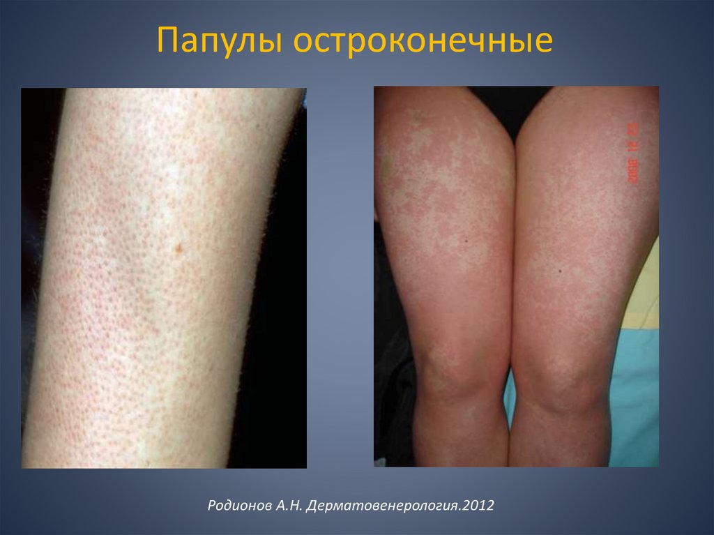 Папулы остроконечные