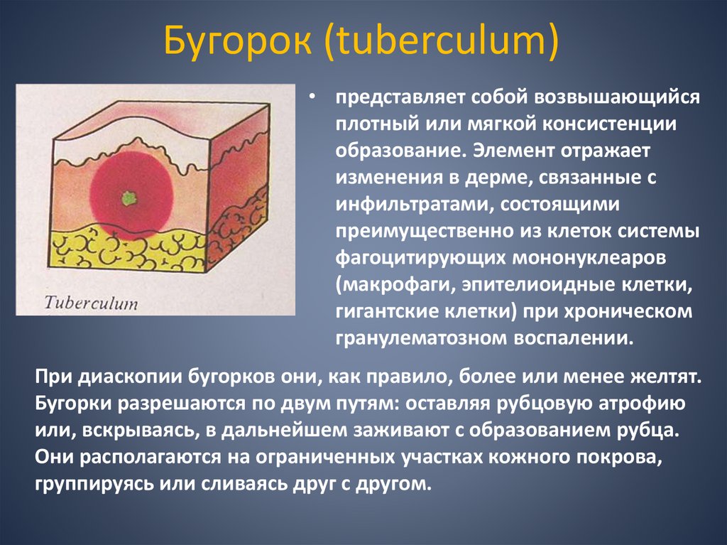 Бугорок (tuberculum)