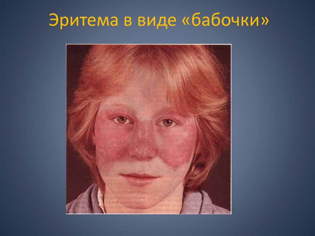 Эритема в виде «бабочки»