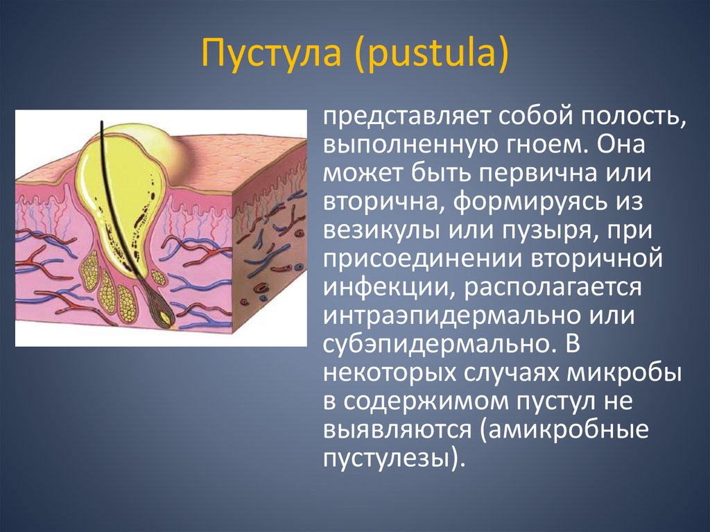 Пустула (pustula)