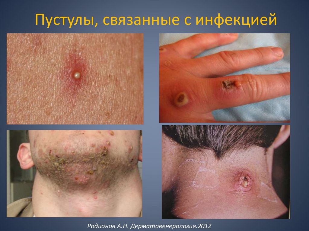 Пустулы, связанные с инфекцией