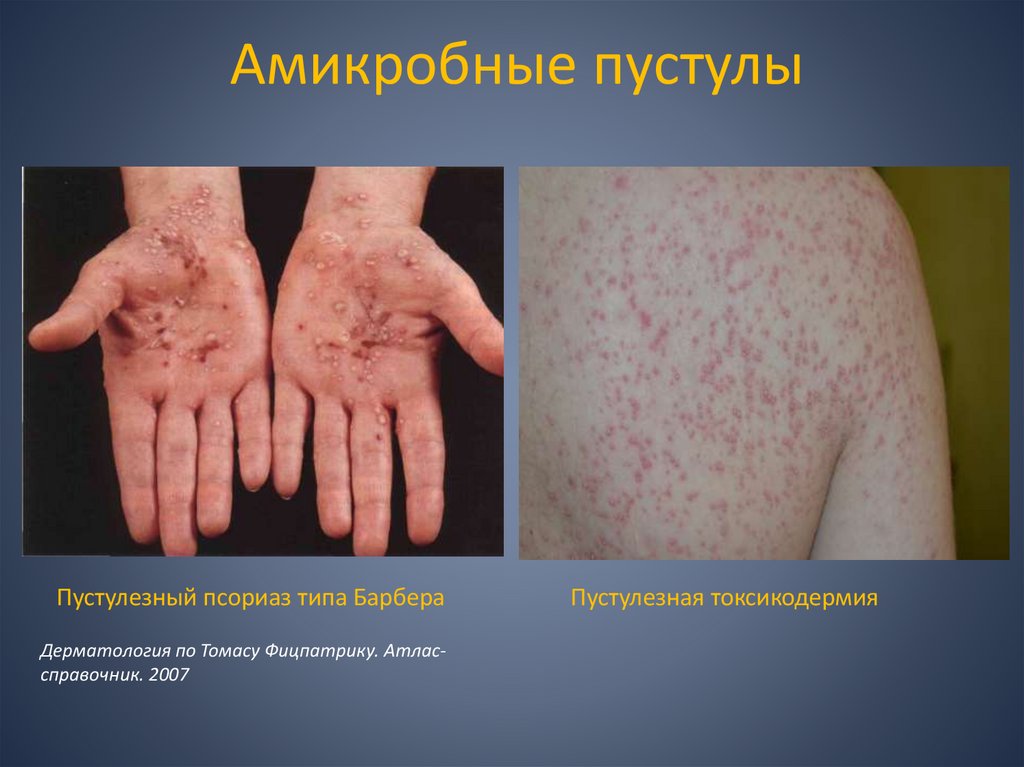 Амикробные пустулы