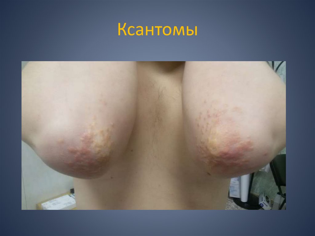 Ксантомы