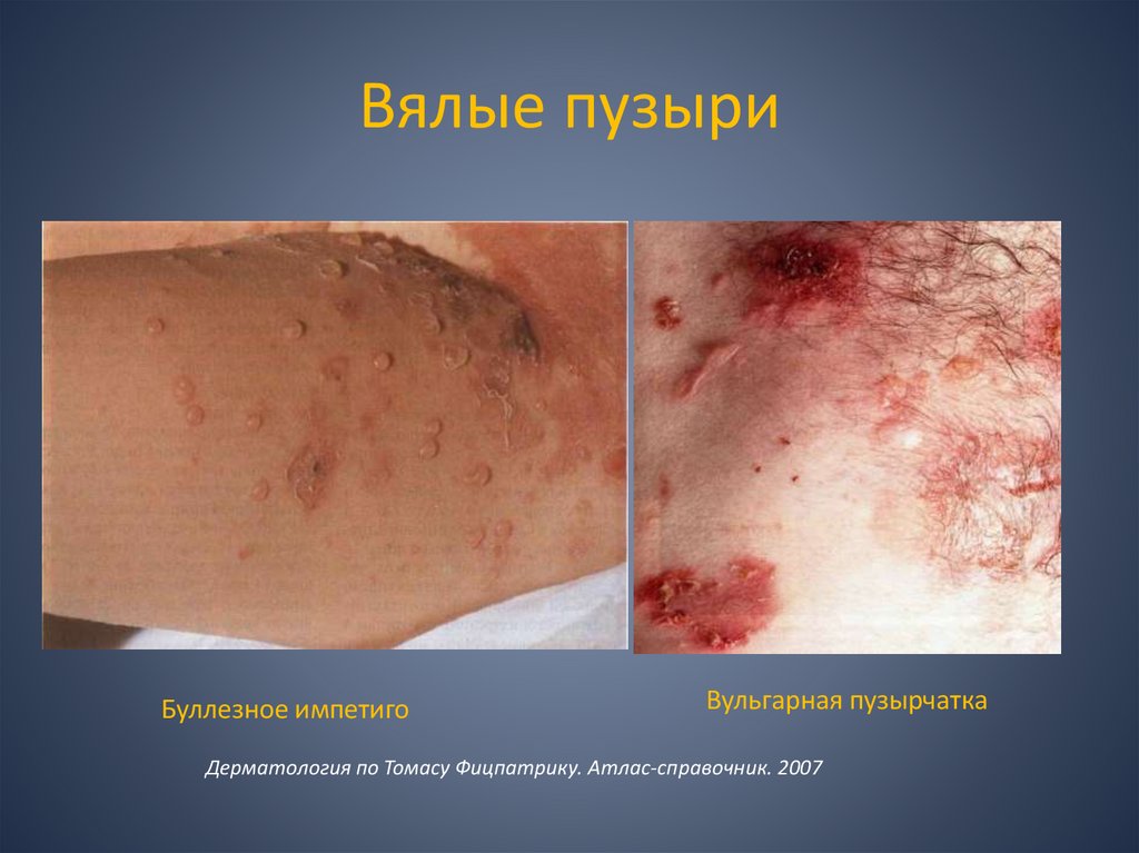 Вялые пузыри