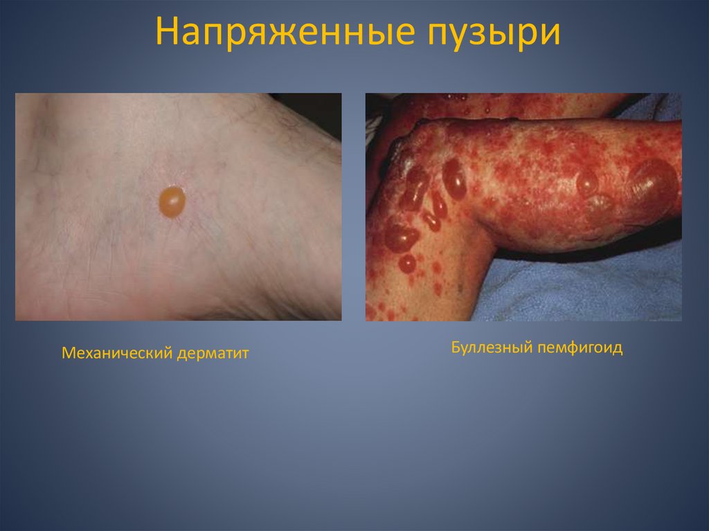 Напряженные пузыри