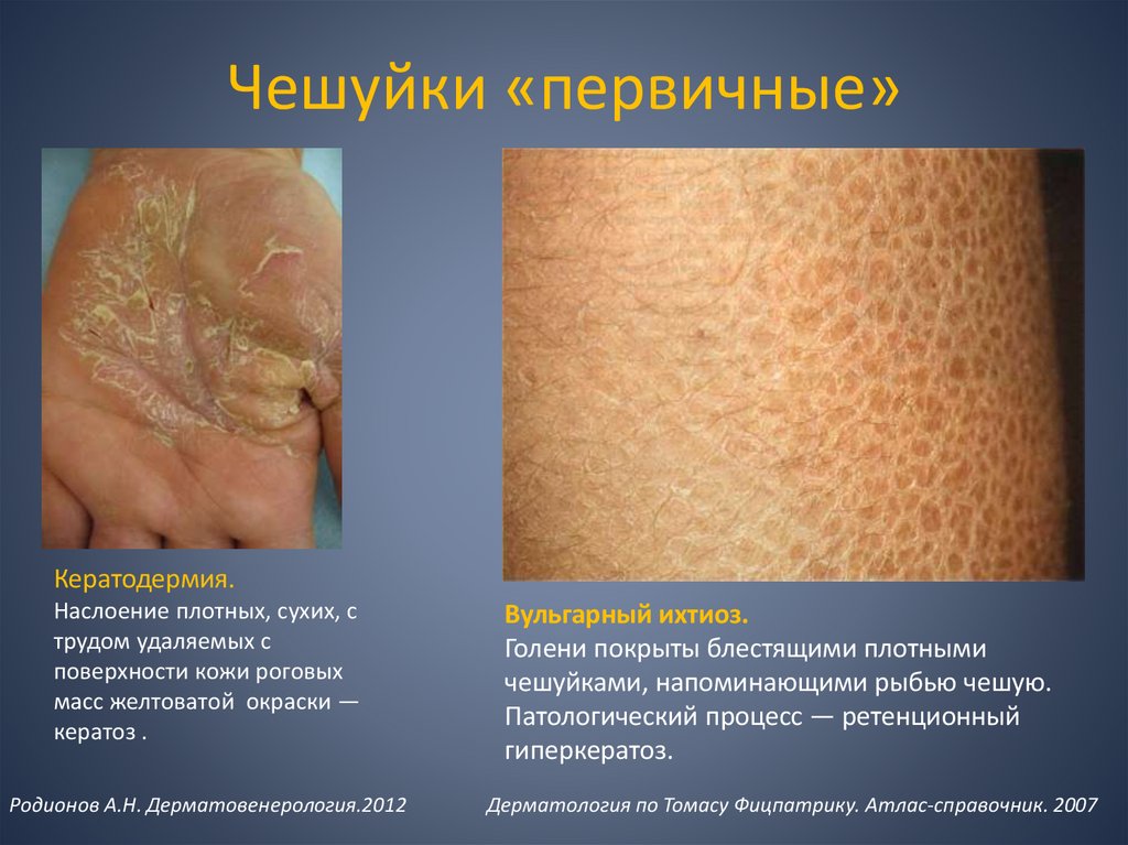 Чешуйки «первичные»