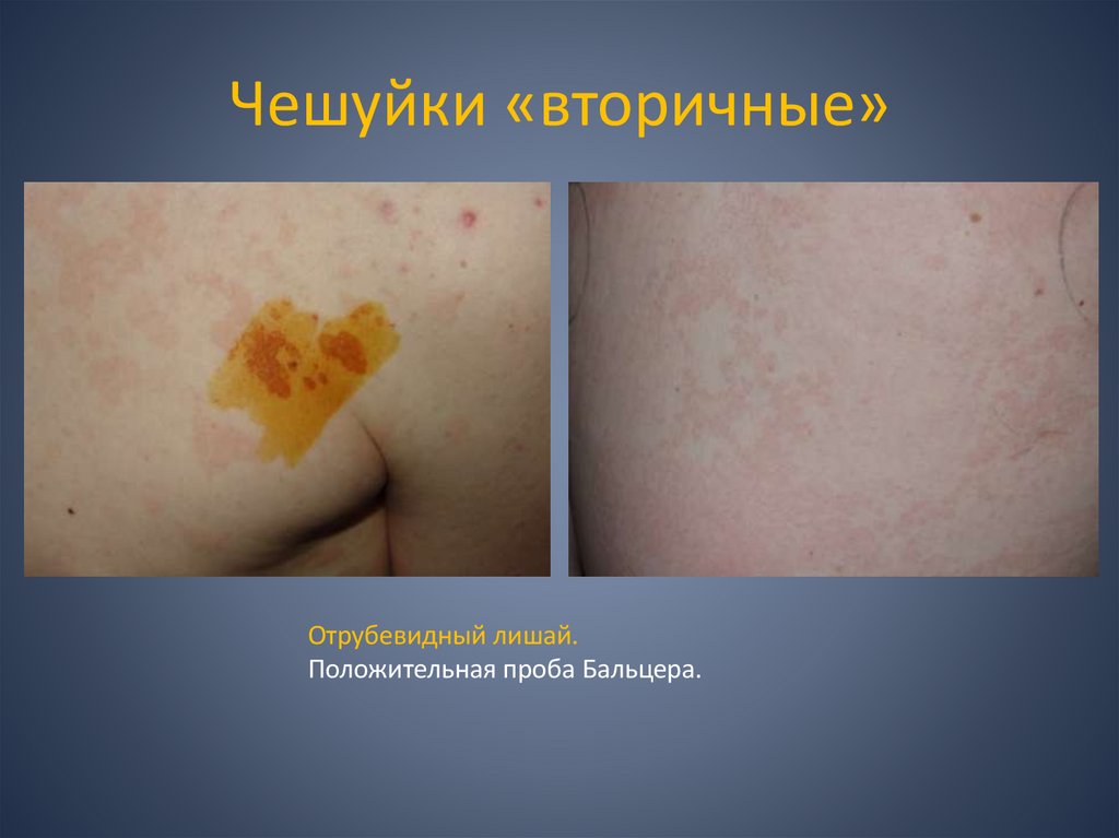 Чешуйки «вторичные»