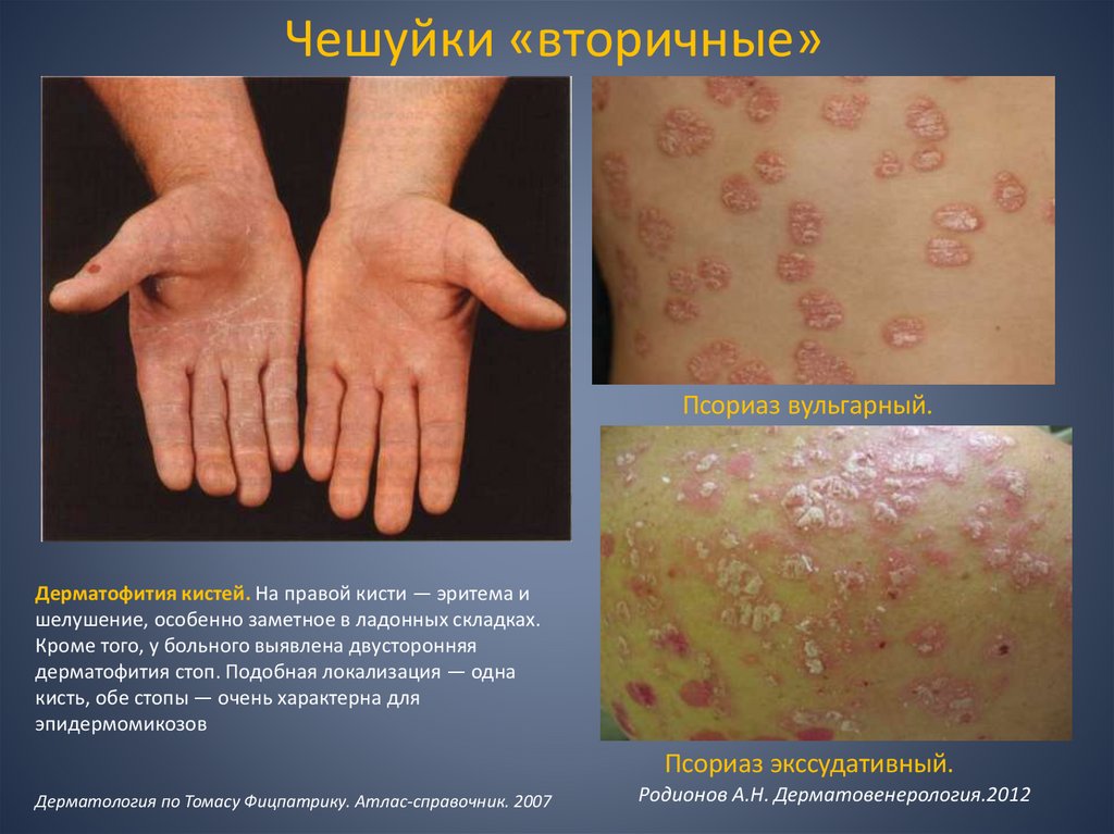 Чешуйки «вторичные»