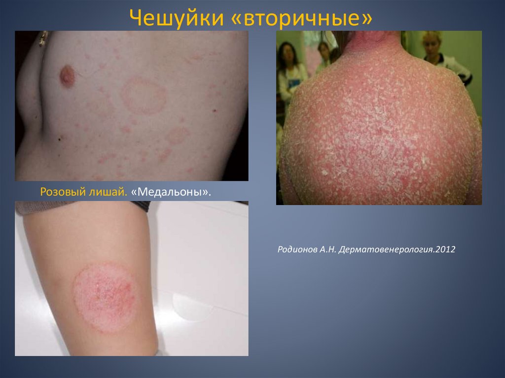 Чешуйки «вторичные»