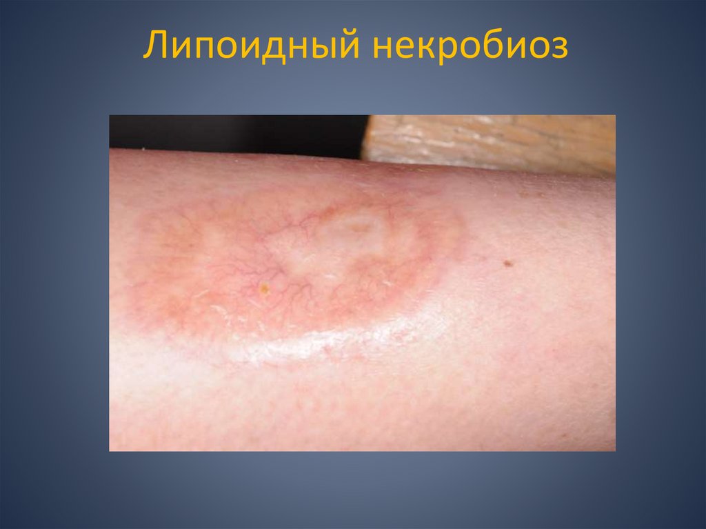 Липоидный некробиоз