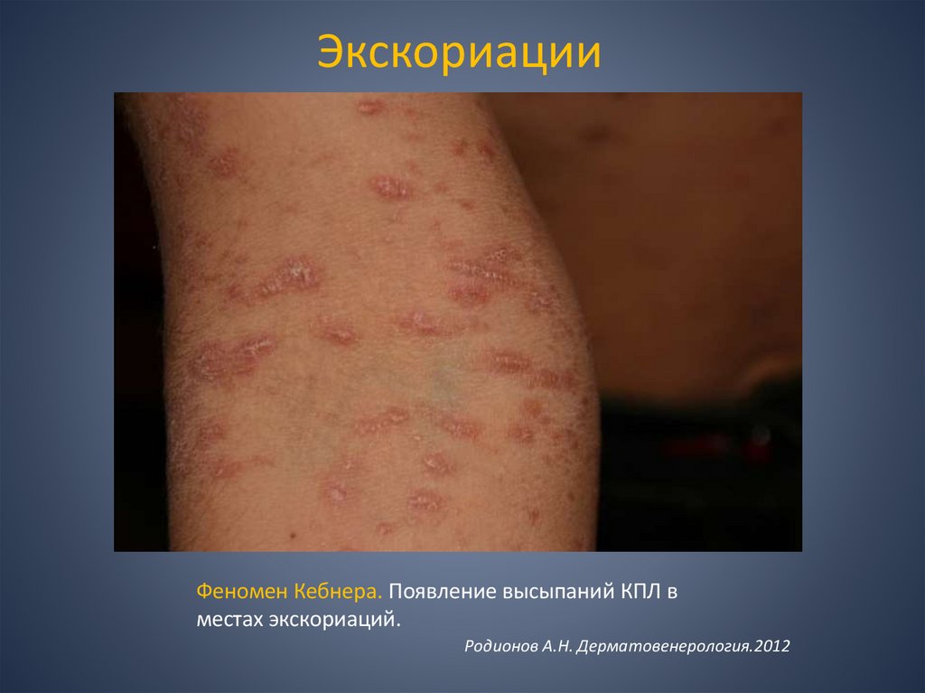 Экскориации