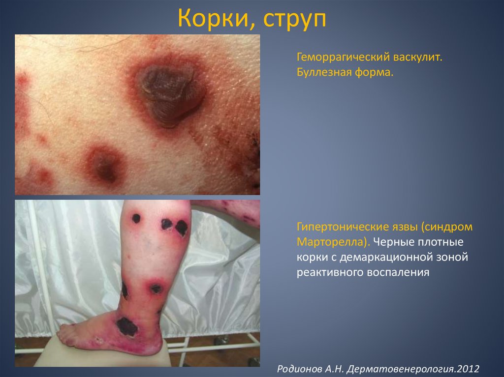 Корки, струп