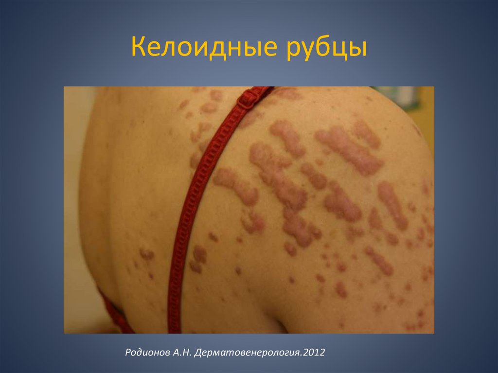 Келоидные рубцы