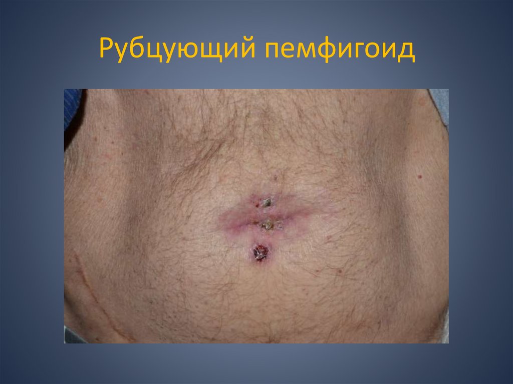 Рубцующий пемфигоид