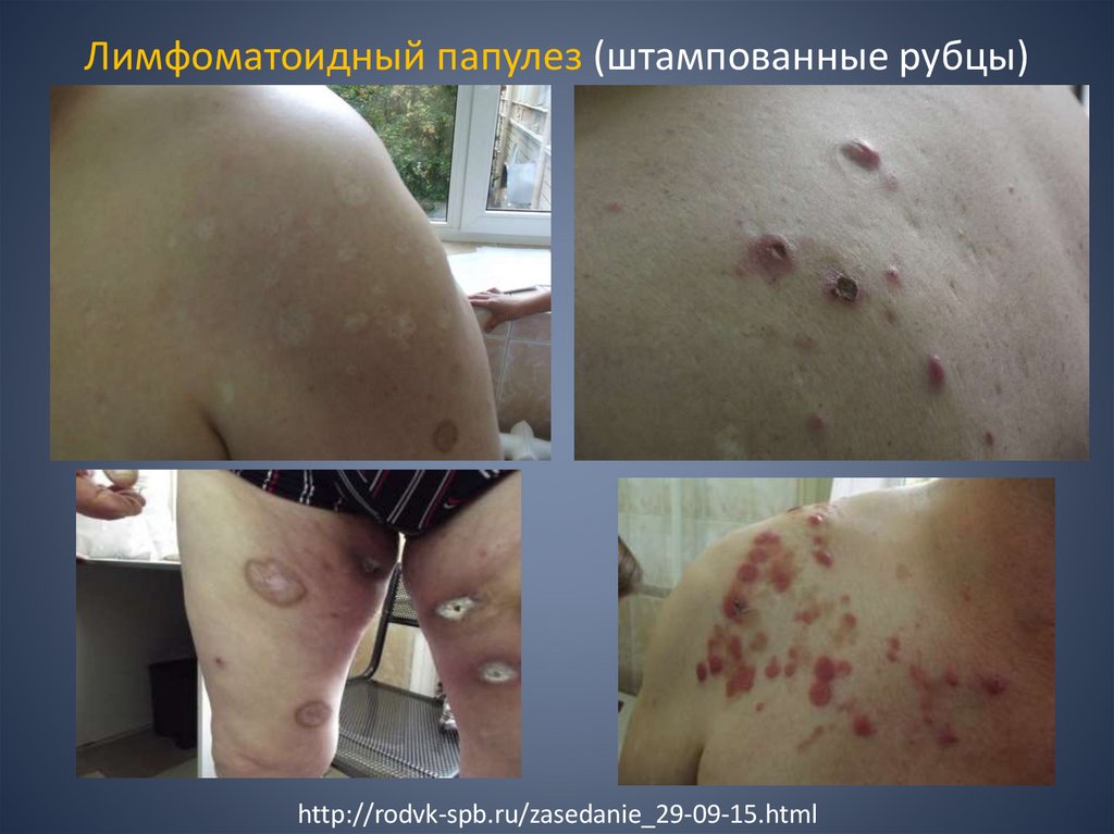 Лимфоматоидный папулез (штампованные рубцы)